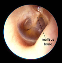 OME